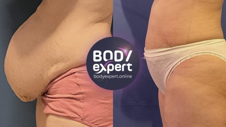 Tummy Tuck Turkey: Affordable transformative care