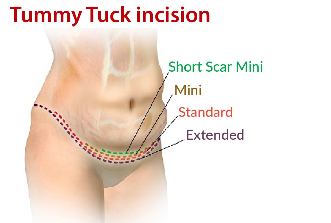 tummy tuck turkey