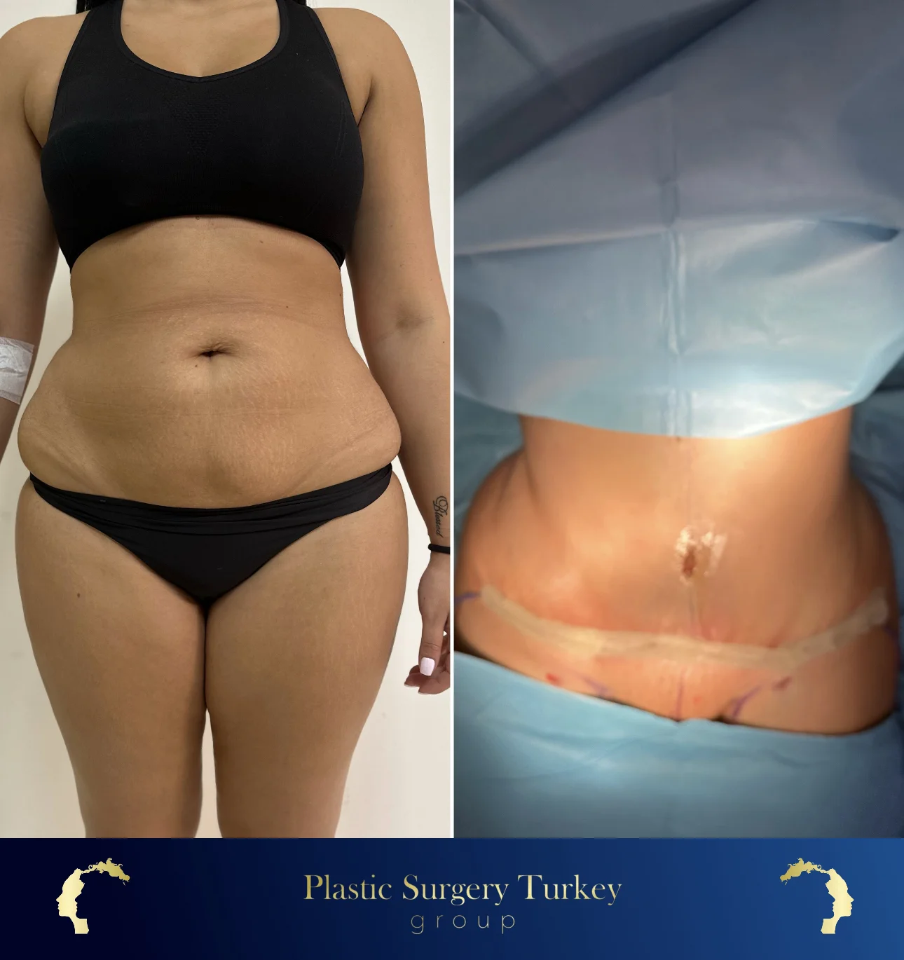 tummy tuck turkey