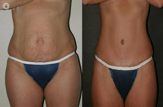 Tummy Tuck Without Surgery: Minimally invasive alternatives