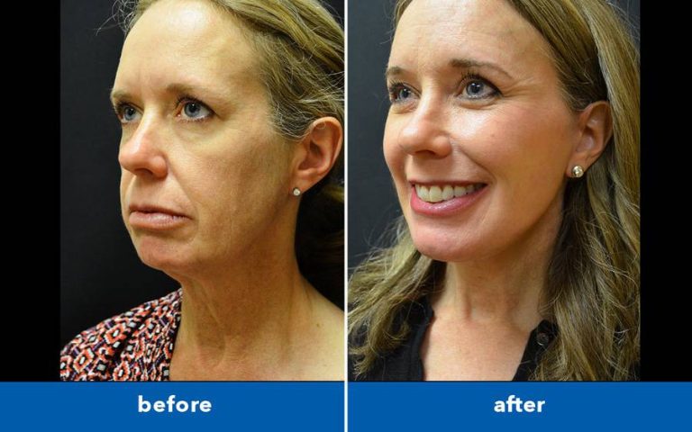Turkey neck surgery: Restoring confidence with neck-tightening solutions