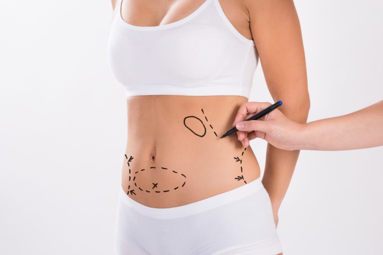 Ultrasonic Liposuction: Advanced fat removal