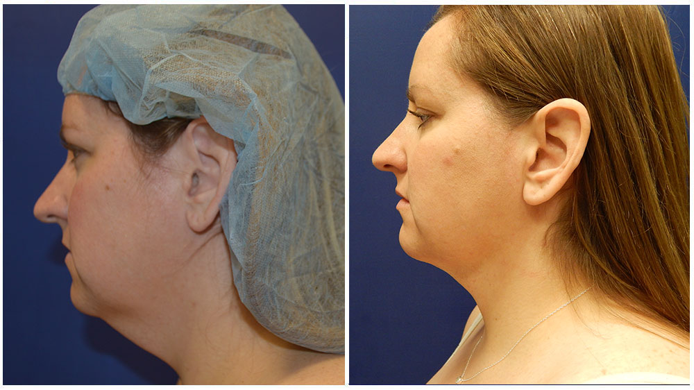under chin lipo under chin lipo