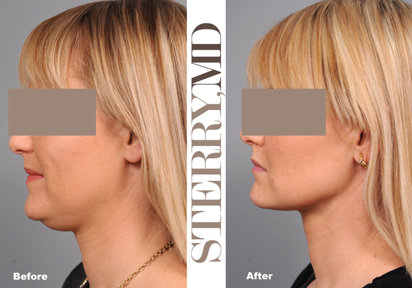 under chin lipo under chin lipo