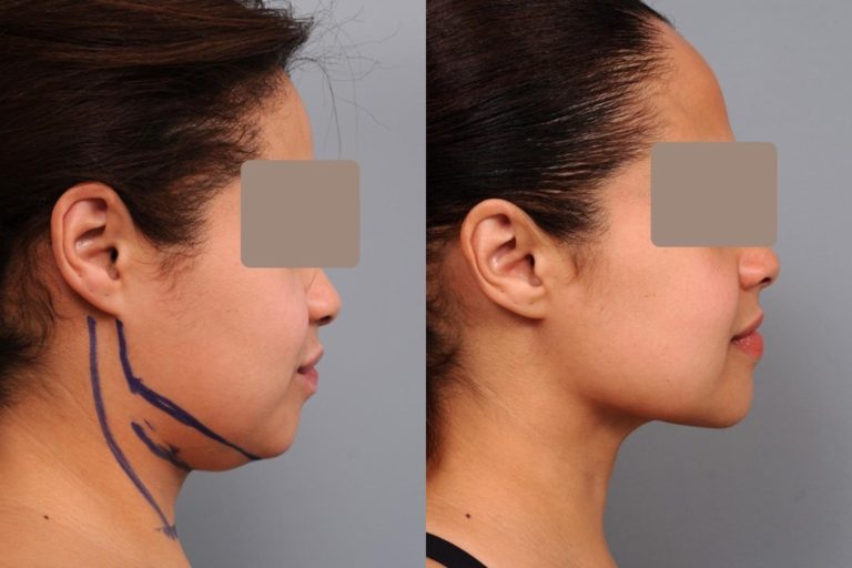 Under Chin Lipo: Precision contouring