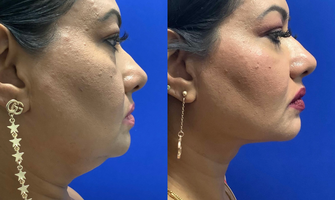under chin lipo under chin lipo