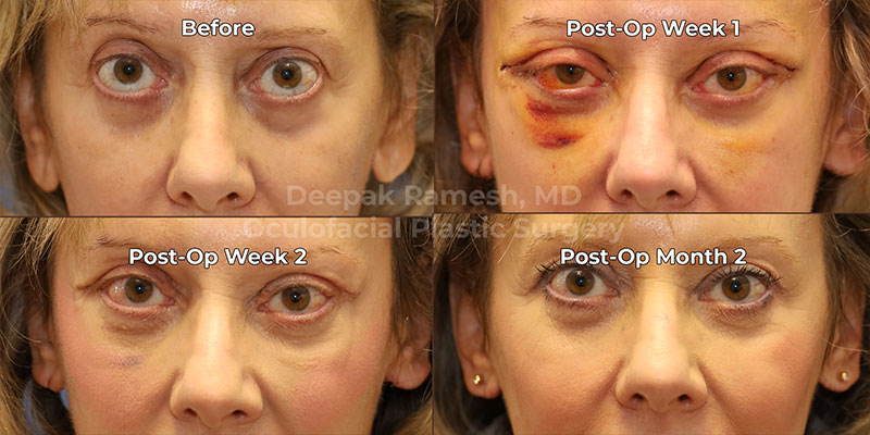 under eye fat transfer