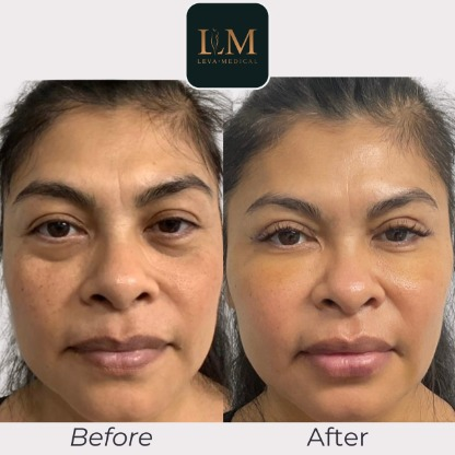 Under-eye fat transfer: Restoring volume to tired eyes