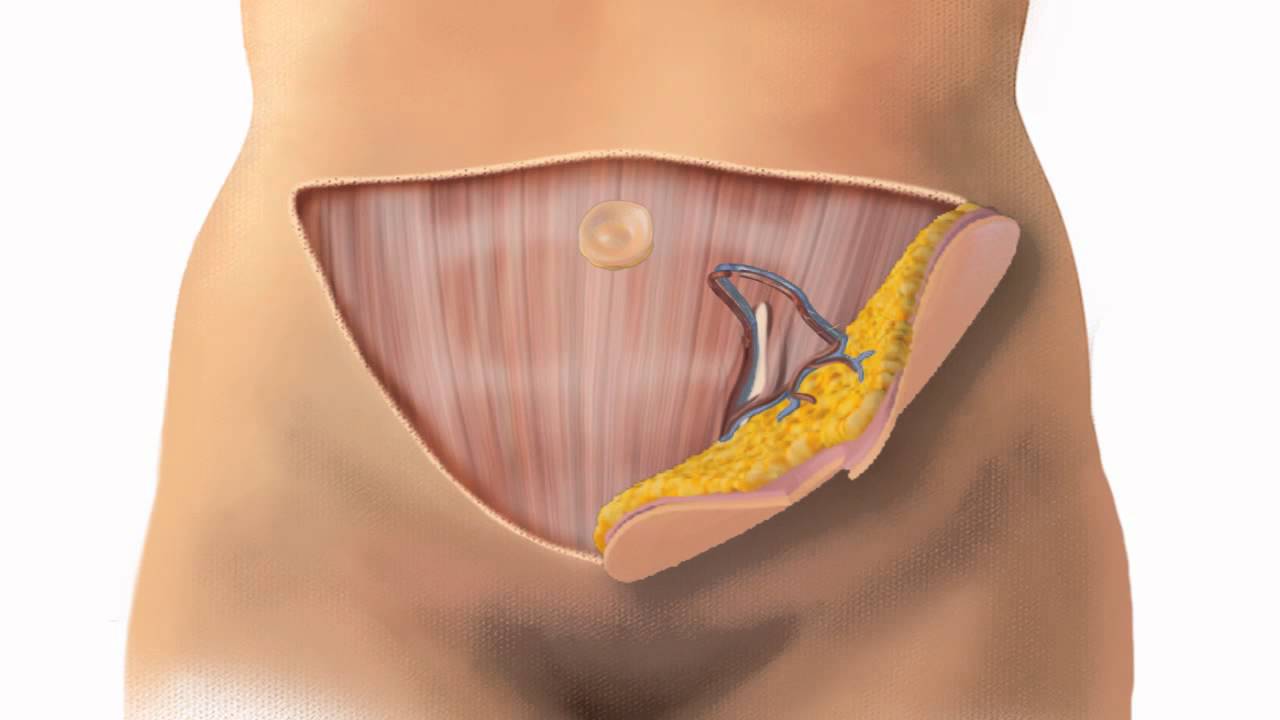diep flap procedure