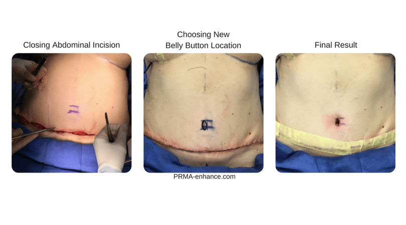 diep flap procedure