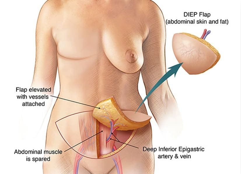 diep flap procedure