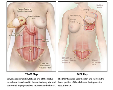 diep flap procedure