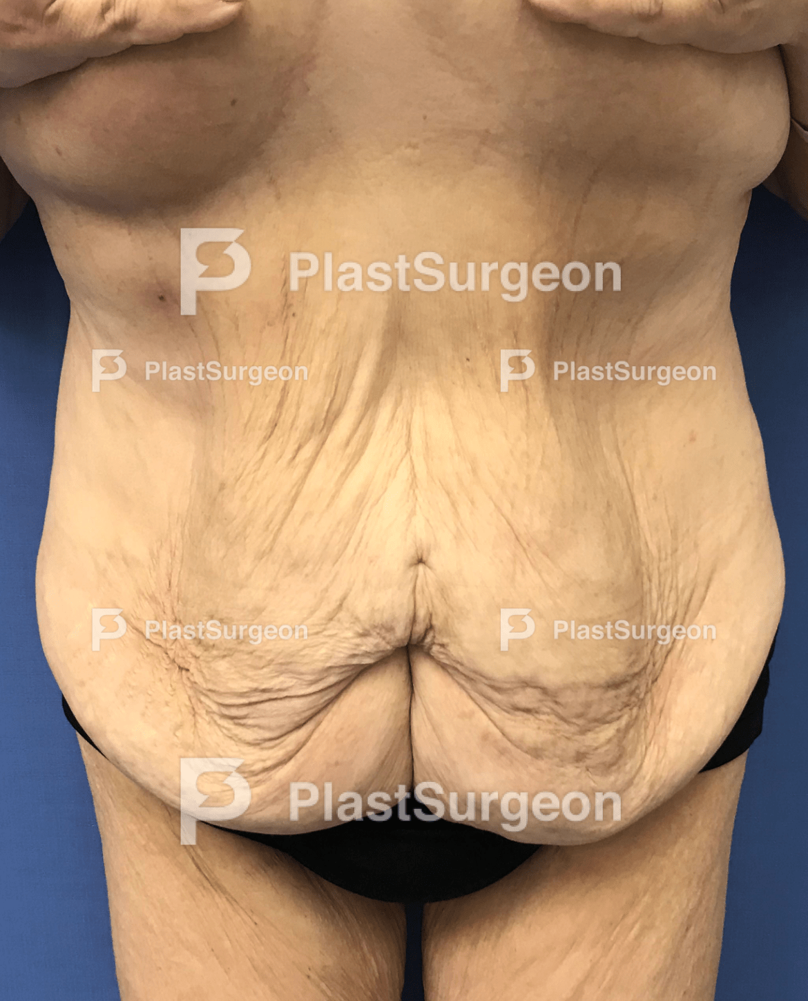 fleur de lis panniculectomy fleur de lis panniculectomy