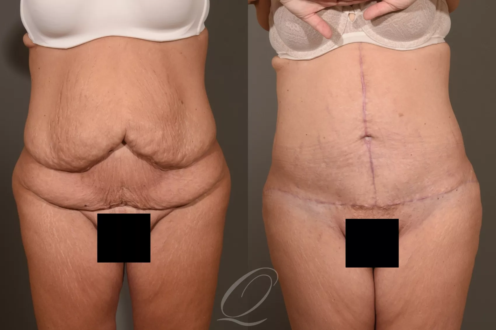 fleur de lis panniculectomy fleur de lis panniculectomy