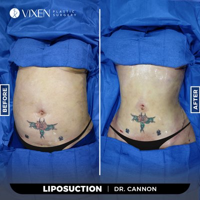 vixen plastic surgery