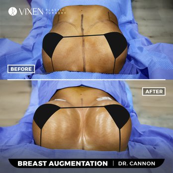 vixen plastic surgery