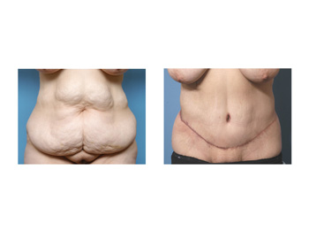 panniculectomy procedure