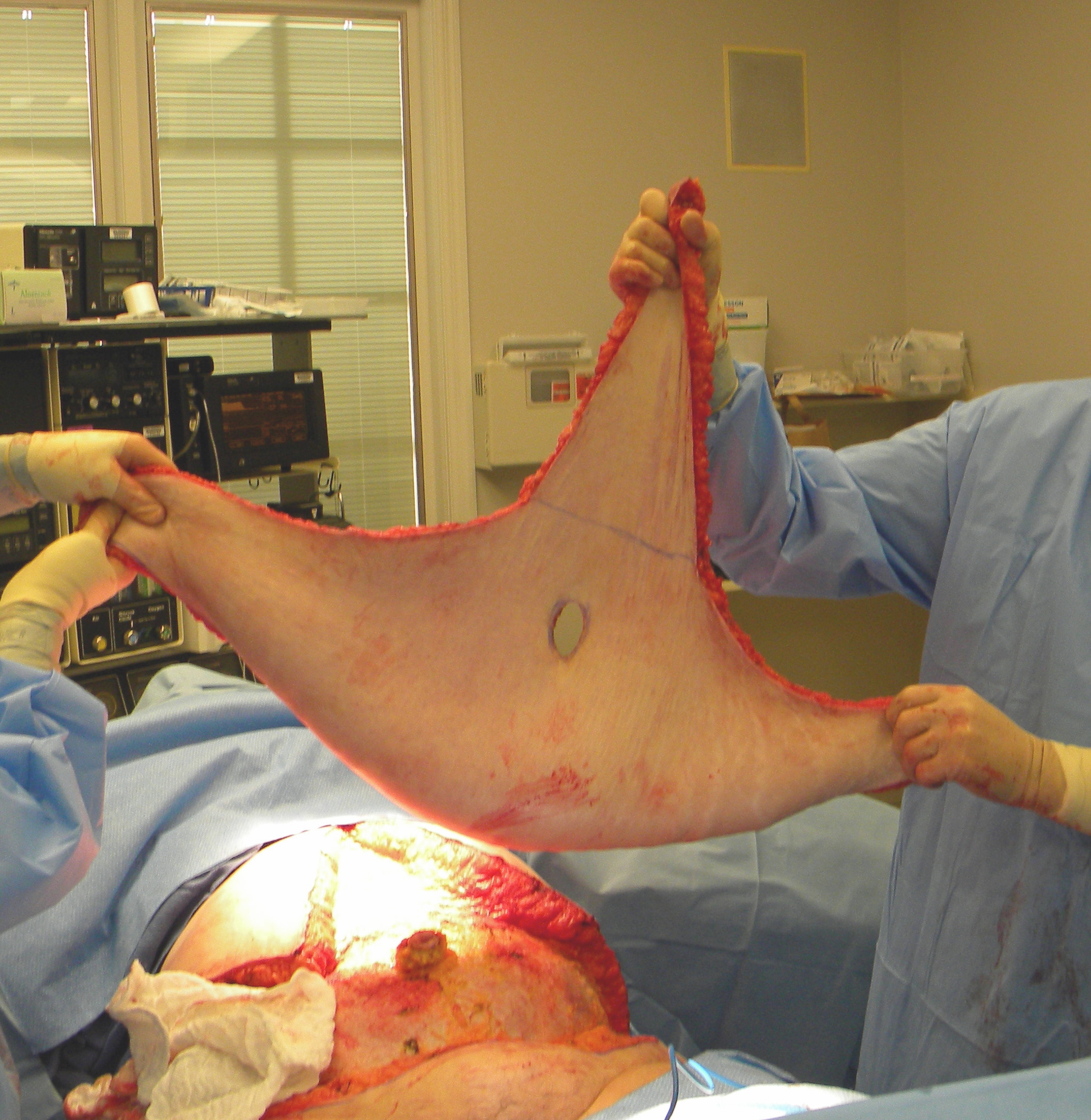 panniculectomy procedure