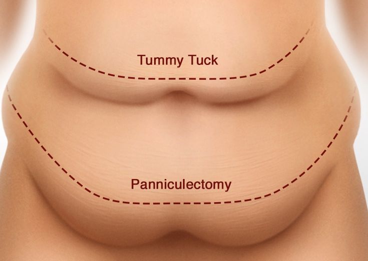 What to Expect During a Panniculectomy Procedure