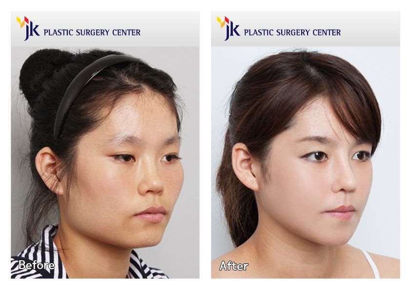 jk plastic surgery