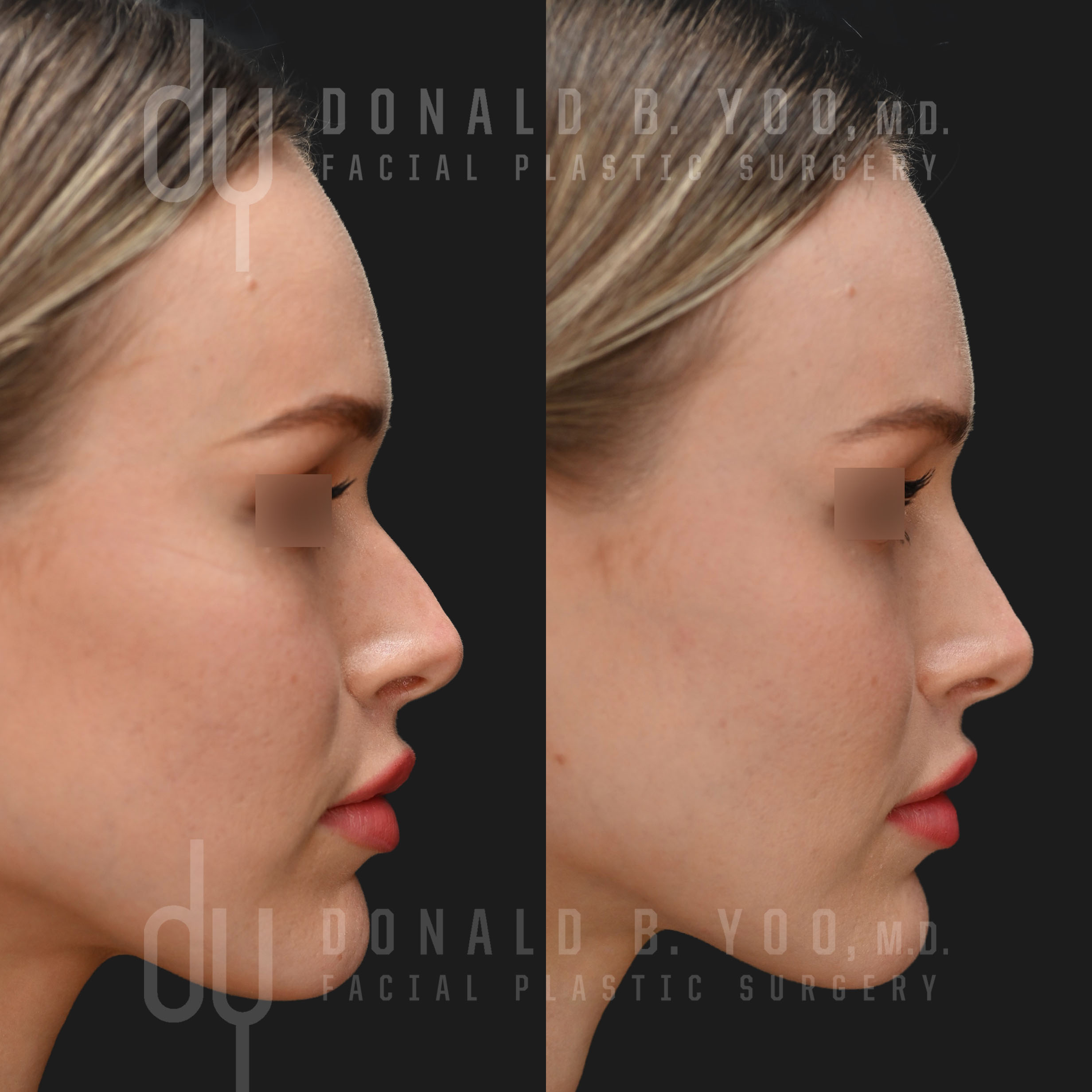 nose lift without surgery