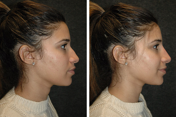 nose lift without surgery