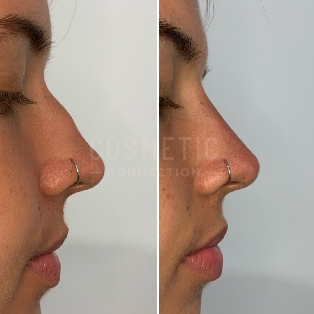 nose lift without surgery