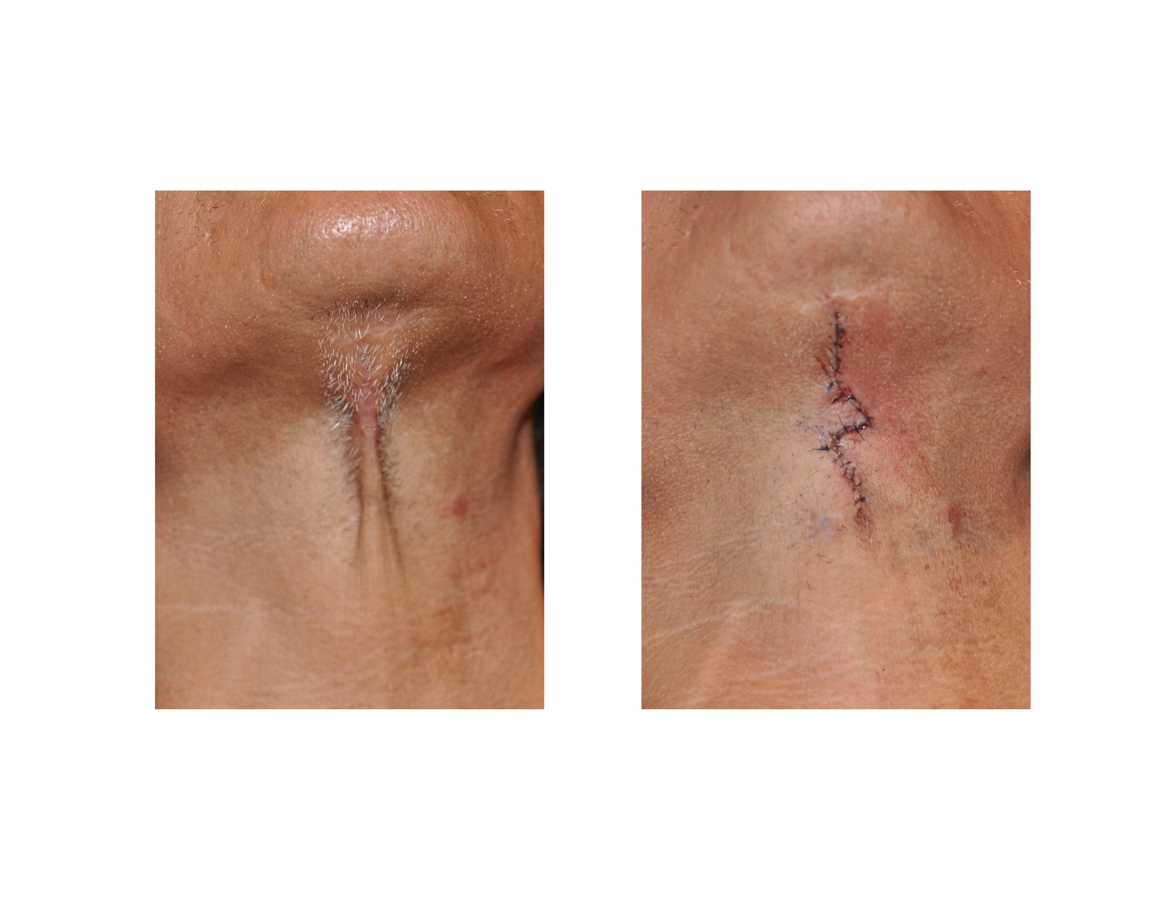 z plasty surgery