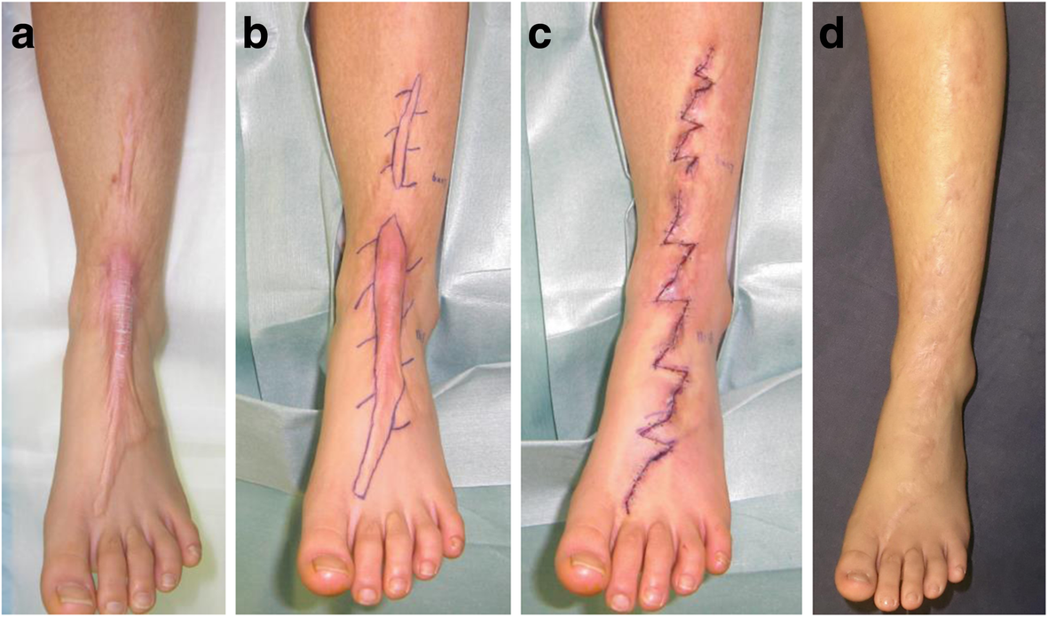 z plasty surgery